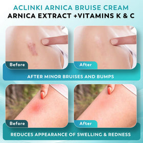 ACLINKI Arnica Bruise Cream in a first aid kit