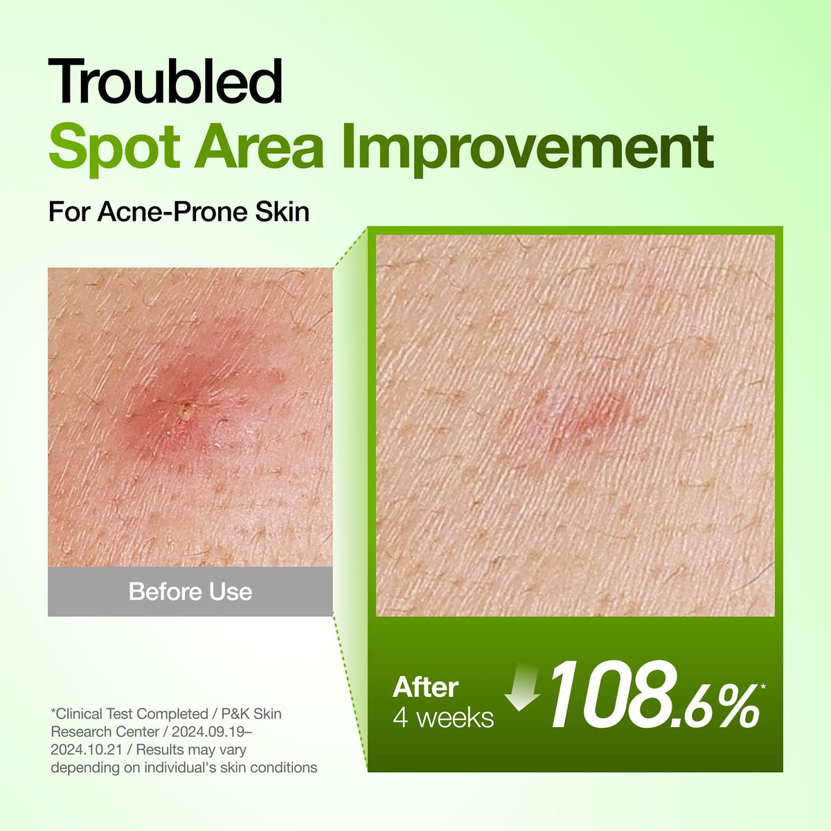 ANUA Azelaic Acid Serum application on skin