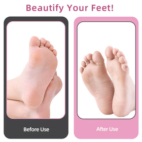 APRELM Electric Foot Callus Remover in use on feet