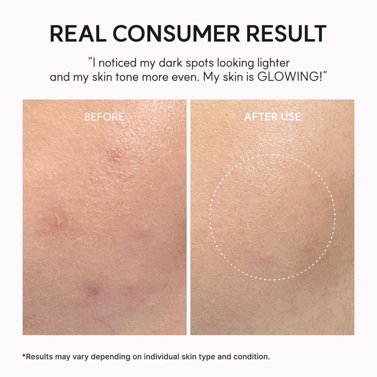 ARENCIA TXA support Shot Serum application on face