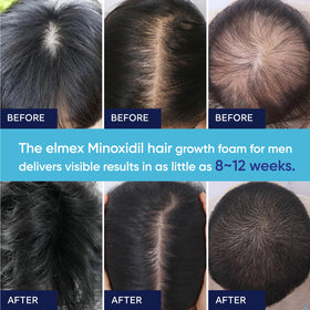Artimore Minoxidil Foam travel-friendly compact bottle