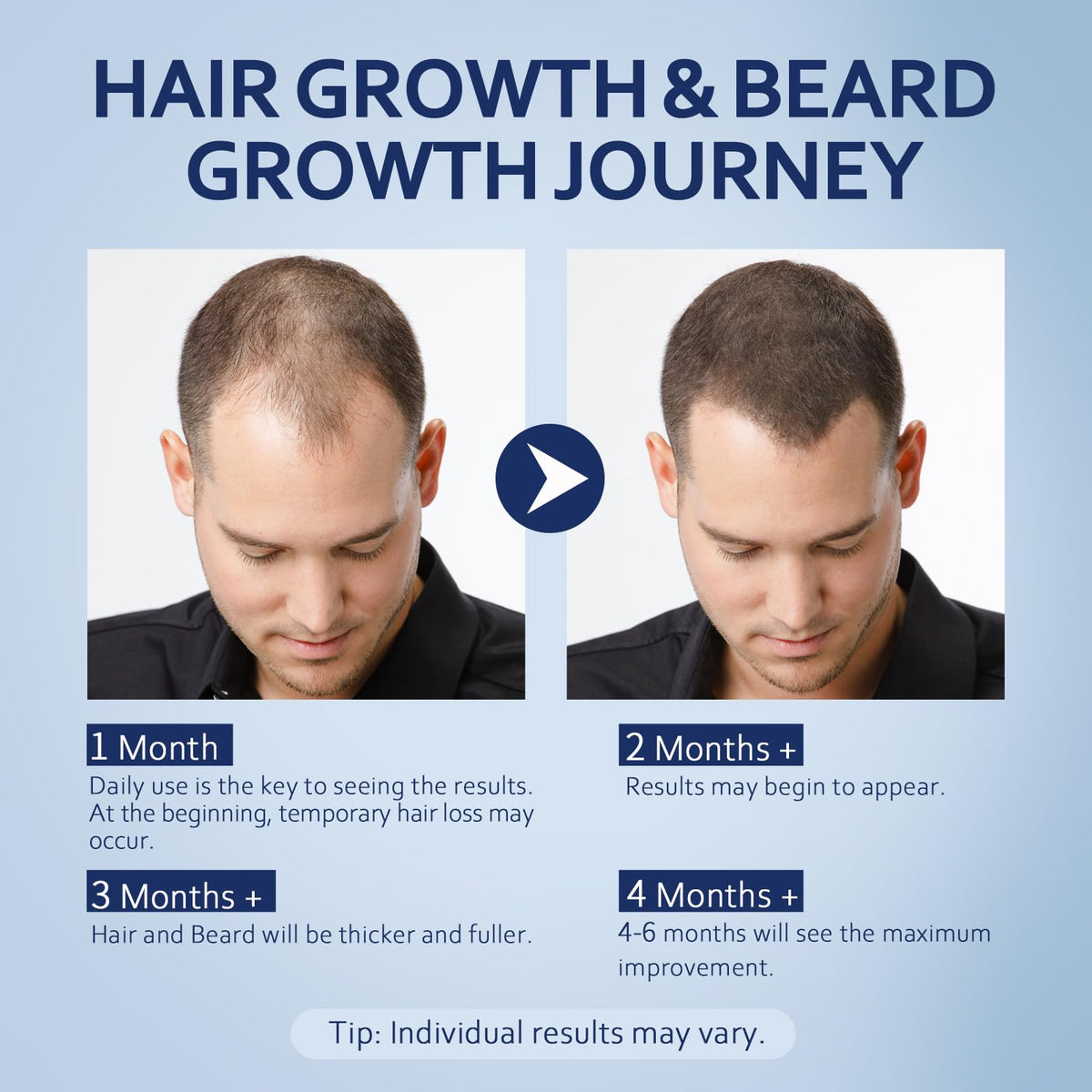 Artimore Minoxidil Hair Growth Serum 5% bottle with ingredients