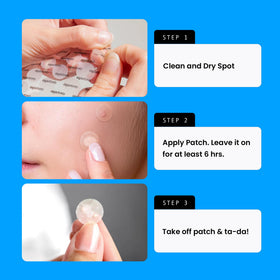 AVARELLE Acne Patches displayed in bulk pack