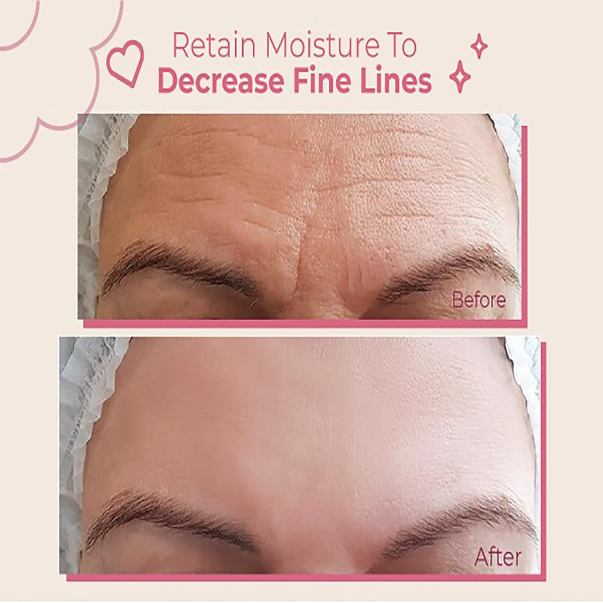 Bayside Forehead Wrinkle Patches close-up of the patches