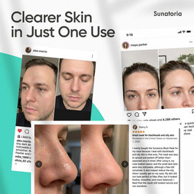 Before and after using SUNATORIA Black Peel Off Mask