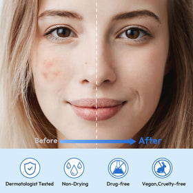 Breiboz Full Face Pimple Patches usage on forehead