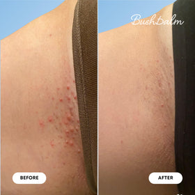 Bushbalm Ingrown Hair Oil 30ml with natural ingredients