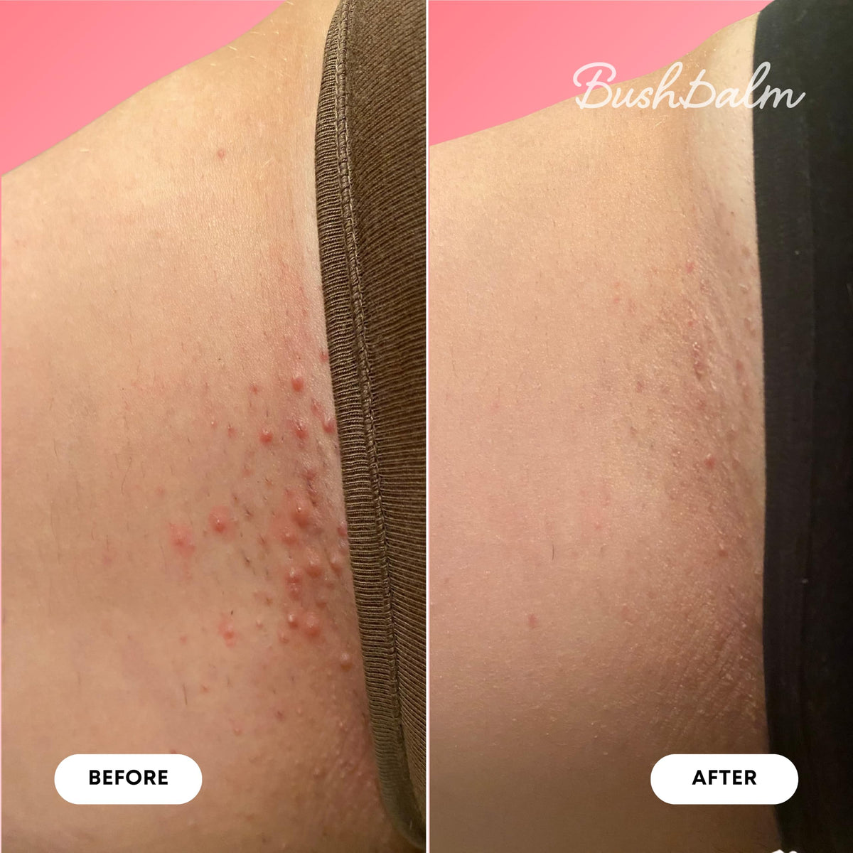 Bushbalm Ingrown Hair Oil Watermelon Sugar 30ml with natural ingredients