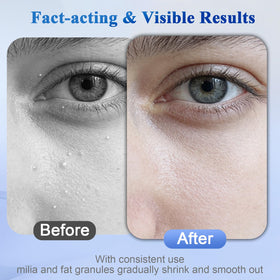 BYT BANGYTONG Milia Remover Serum with ingredients list