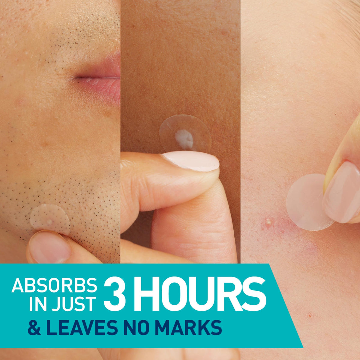 CeraVe Hydrocolloid Pimple Patches close-up of patches