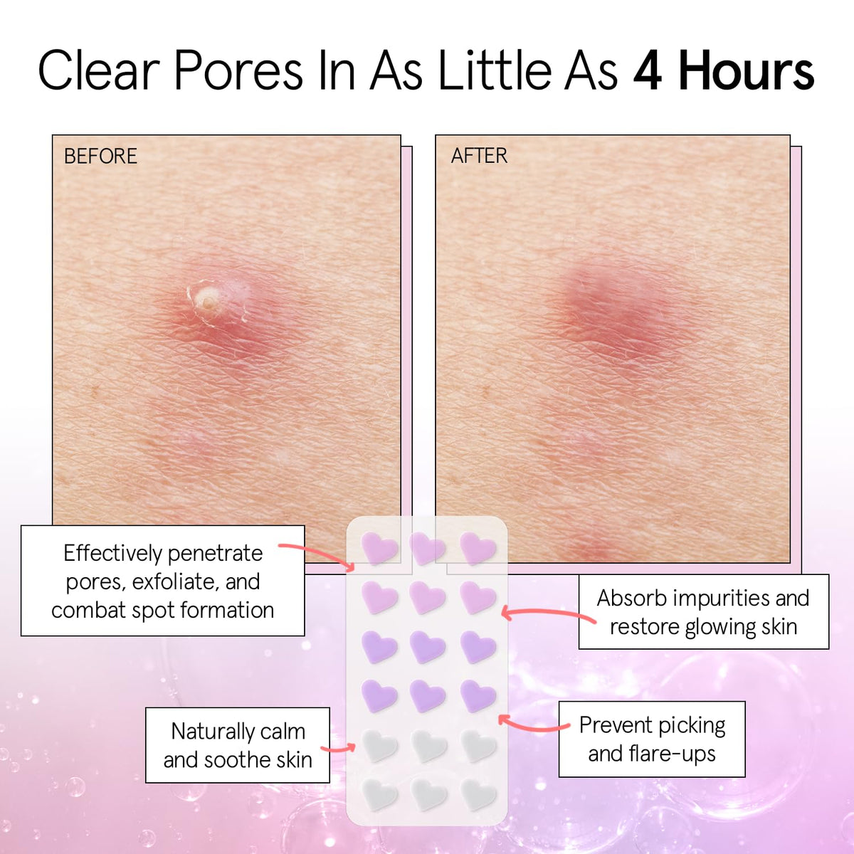 close-up of grace & stella hydrocolloid acne patch on skin