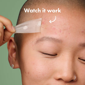 Close-up of Mighty Patch Surface hydrocolloid patch