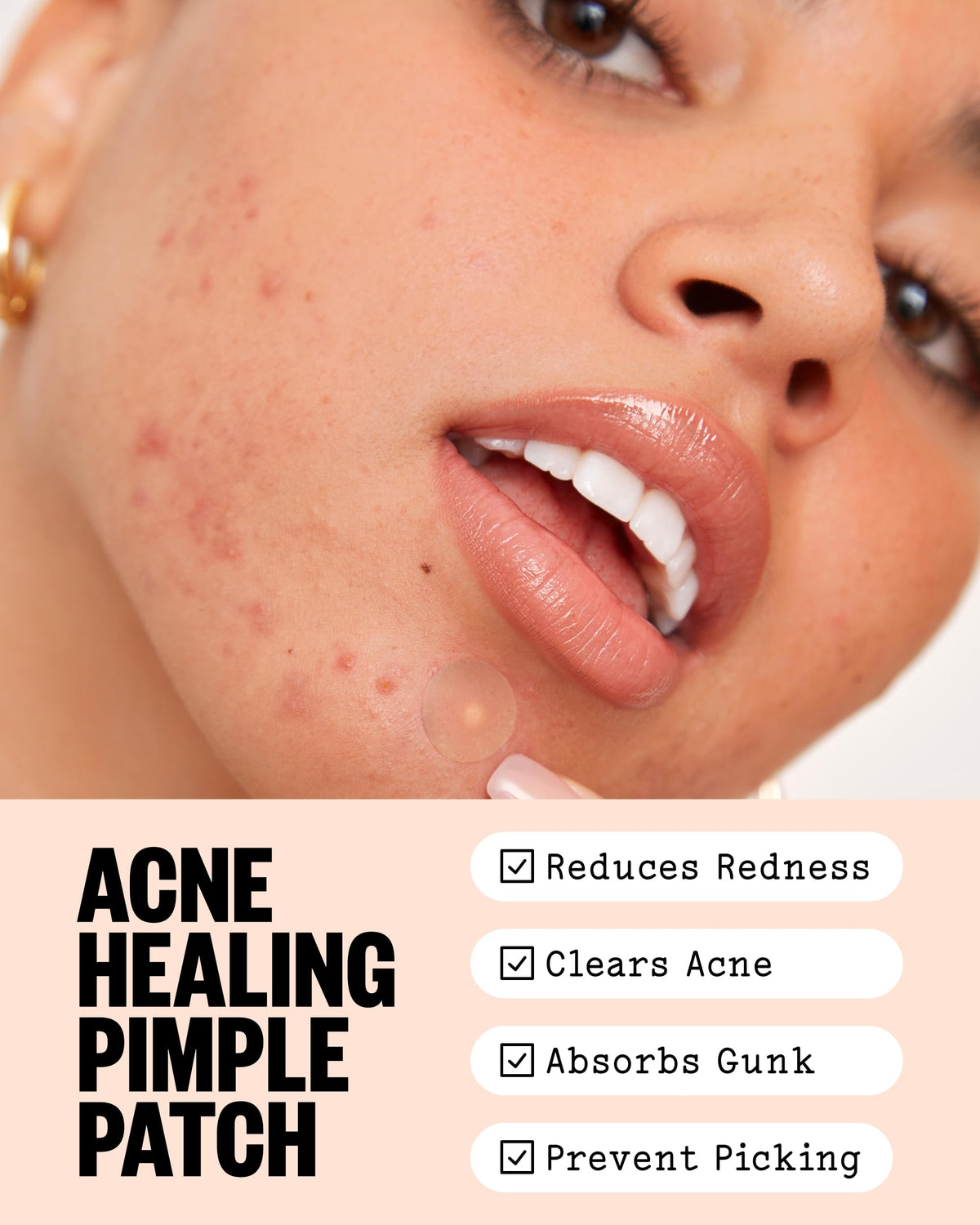 Close-up of PEACE OUT Acne Healing Dots on skin