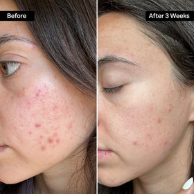 Close-up of QRxLabs Salicylic & Glycolic Acid Pad texture