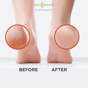 DAILY REMEDY Muscle Relief Foot Soak with Epsom salt