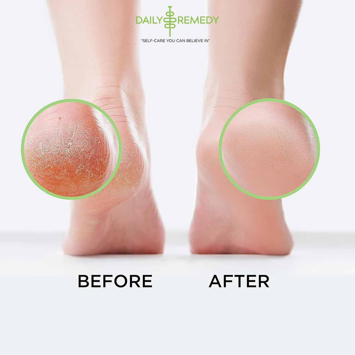 DAILY REMEDY Tea Tree Oil Foot Soak with Epsom salt