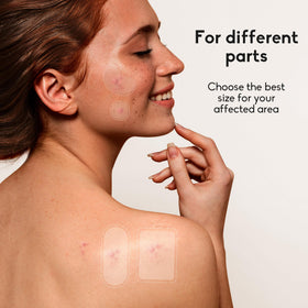 Daolyo Large Acne Pimple Patches oval patches close-up