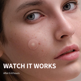 Daolyo Pimple Patches showing natural ingredients