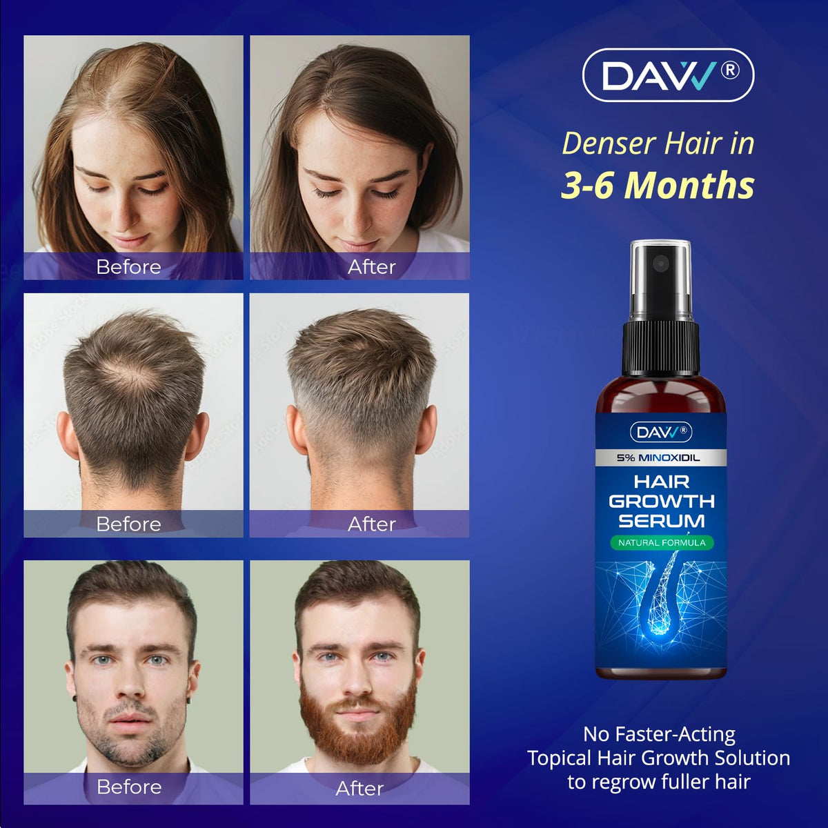 DAVV Minoxidil Spray bottle with label details