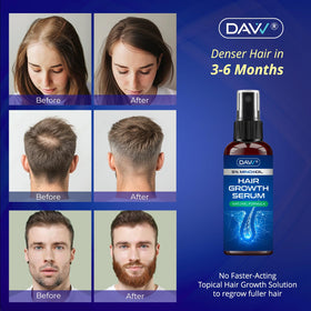 DAVV Minoxidil Spray bottle with label details