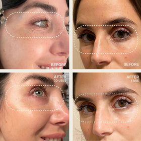 Dermaclara Silicone Eye and Mouth Wrinkle Patches displayed