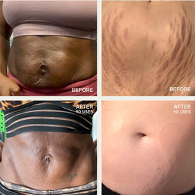 Dermaclara Silicone Patch in use during pregnancy