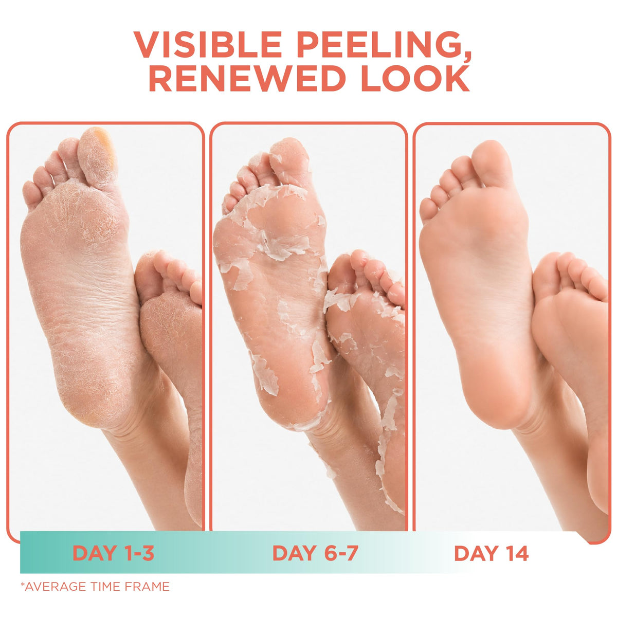 DERMORA Foot Peel Mask in use, feet inside booties