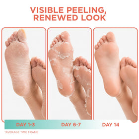DERMORA Foot Peel Mask in use, feet inside booties