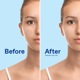 Differin Acne Face Wash 10% Benzoyl Peroxide packaging