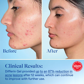 Differin Acne Gel 15g tube with ingredients list