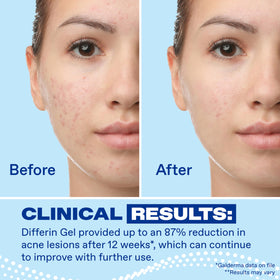 Differin Acne Gel texture on hand