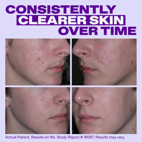 Differin Epiduo Acne Gel application on skin