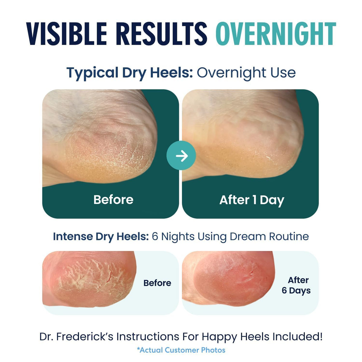 Dr. Frederick's heel socks being worn on feet