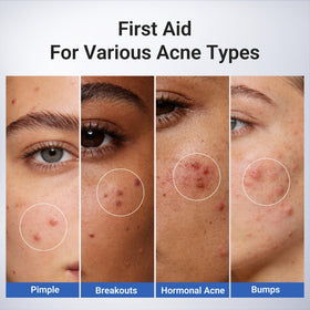 Dr.Leo Acne Spot application with cotton swab