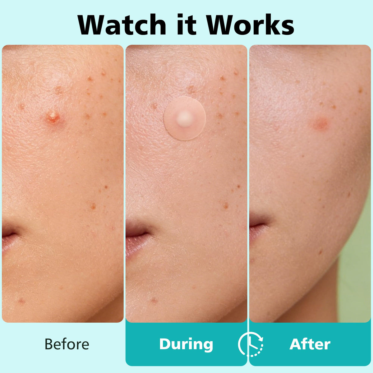 Dr.patch pimple patch applied on skin