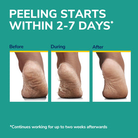 Dr. Scholl's foot peeling mask in use on feet