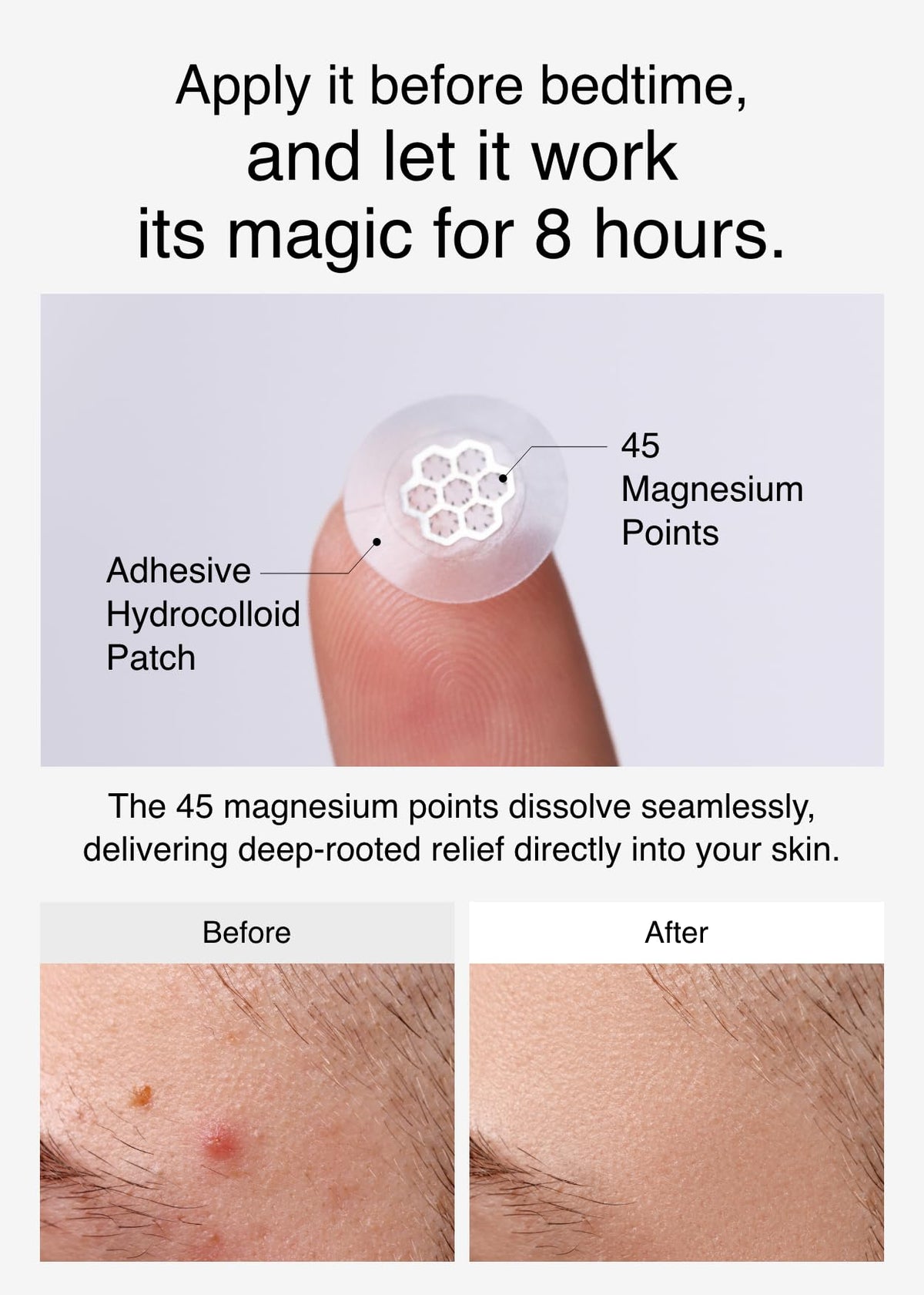 DWEasyDerm Quick Microdart Pimple Patch application on skin