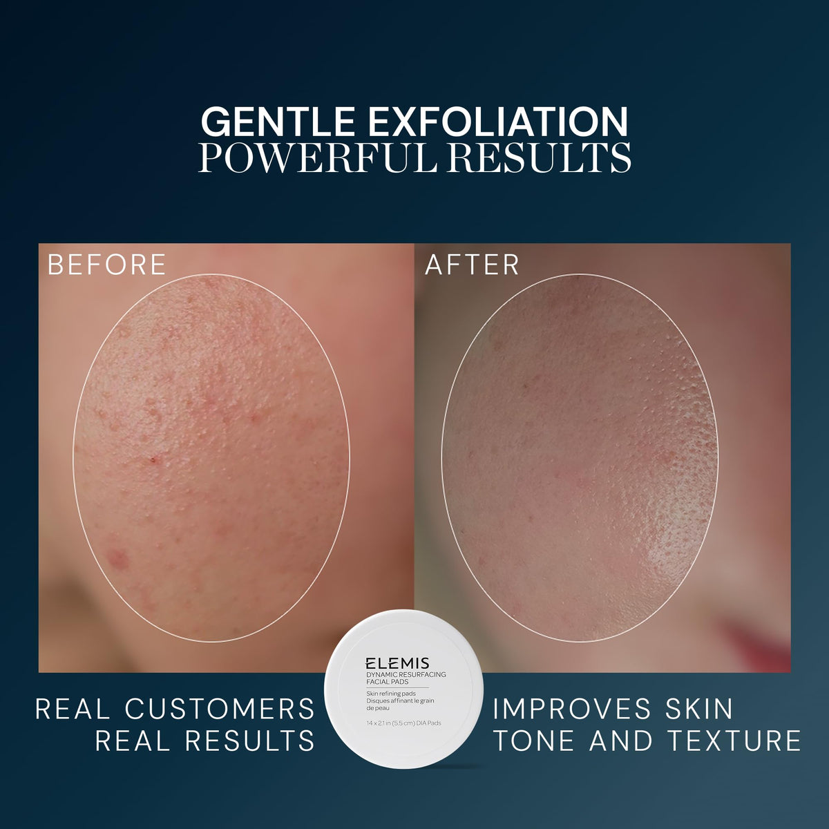 ELEMIS Dynamic Resurfacing Facial Pads showing smooth side