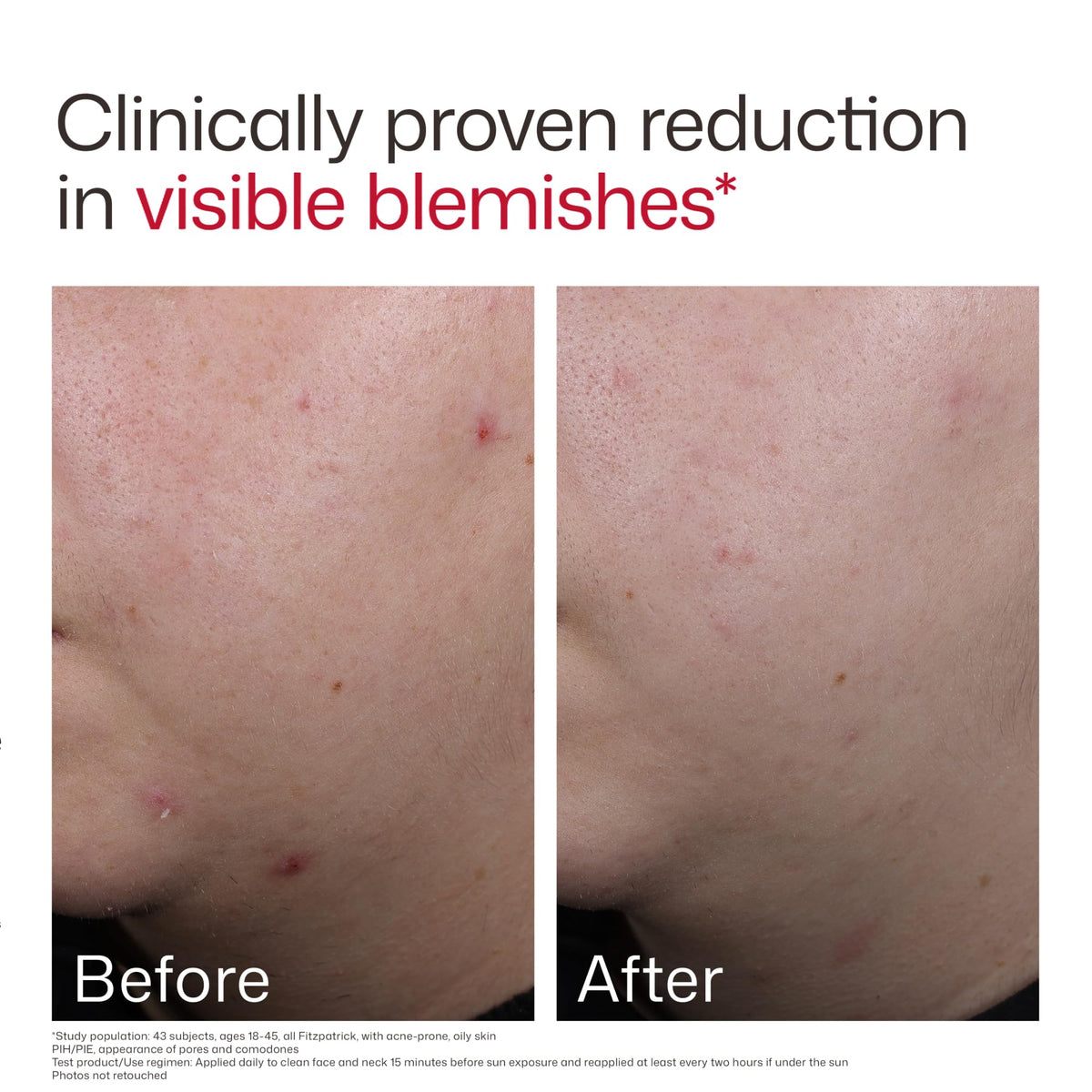 EltaMD UV Clear Blemish-Prone Oil Balancing SPF 50 texture close-up