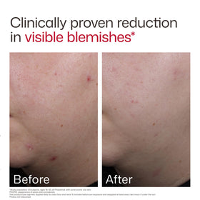 EltaMD UV Clear Blemish-Prone Oil Balancing SPF 50 texture close-up