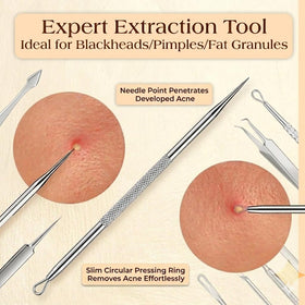 Ergonomic handle of DERMATED pimple popper tool