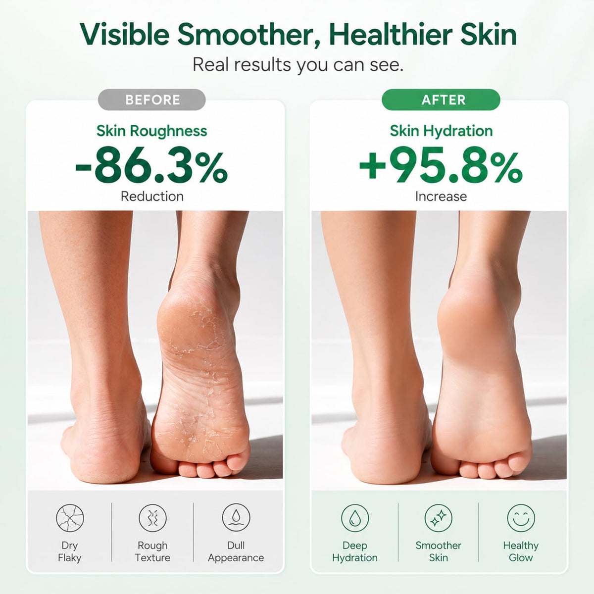 FAMIKYA Urea Cream 40% application on feet