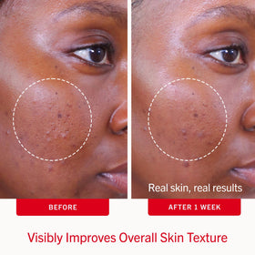 First Aid Beauty Acne Pads close-up of a pad