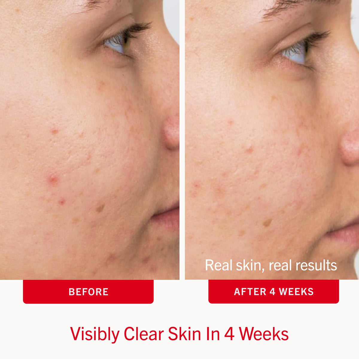 First Aid Beauty Acne Pads lifestyle scene with user
