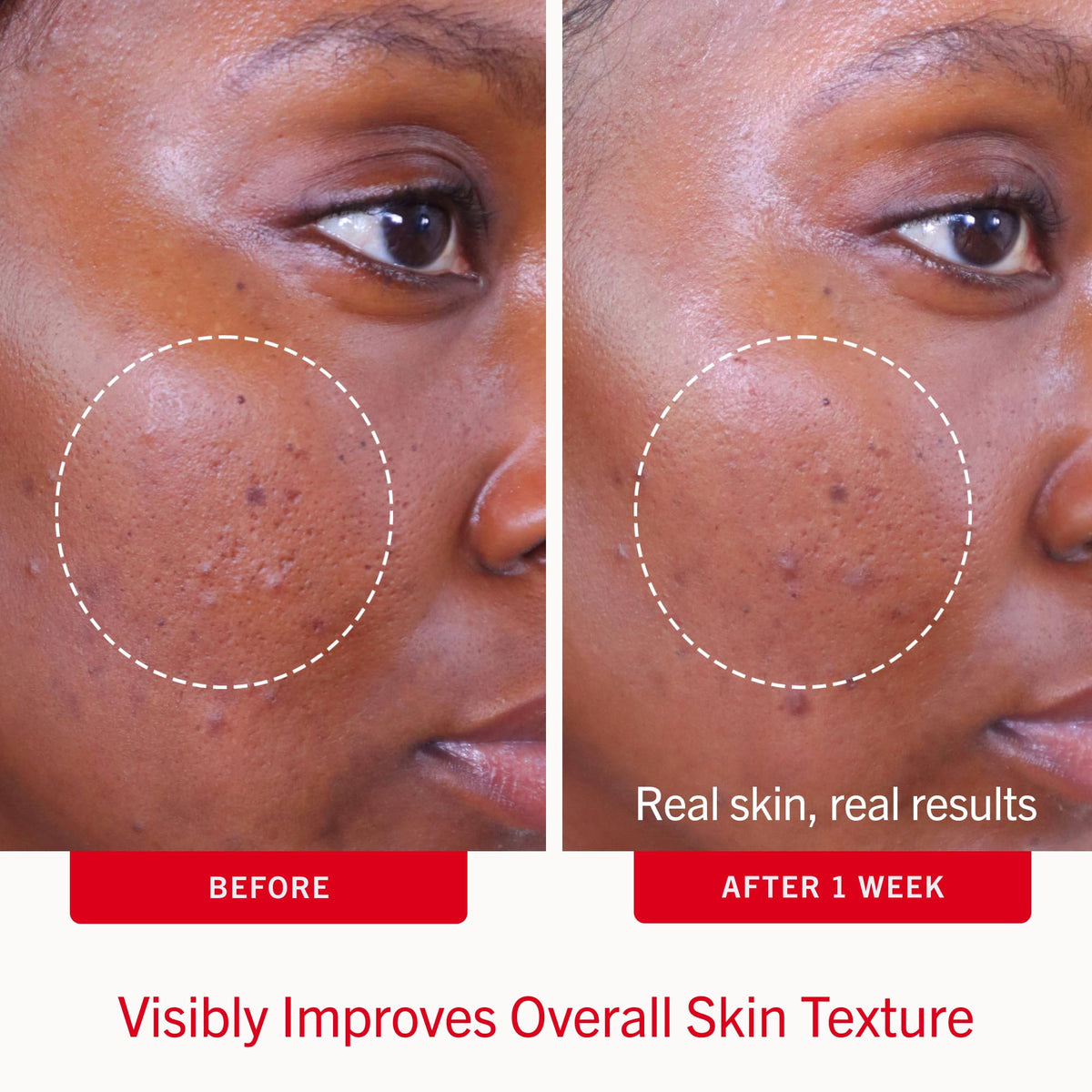 First Aid Beauty Acne Pads showing texture of the pad