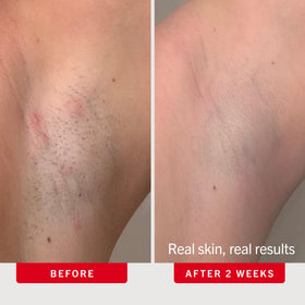 First Aid Beauty Ingrown Hair Pads displayed on a bathroom countertop