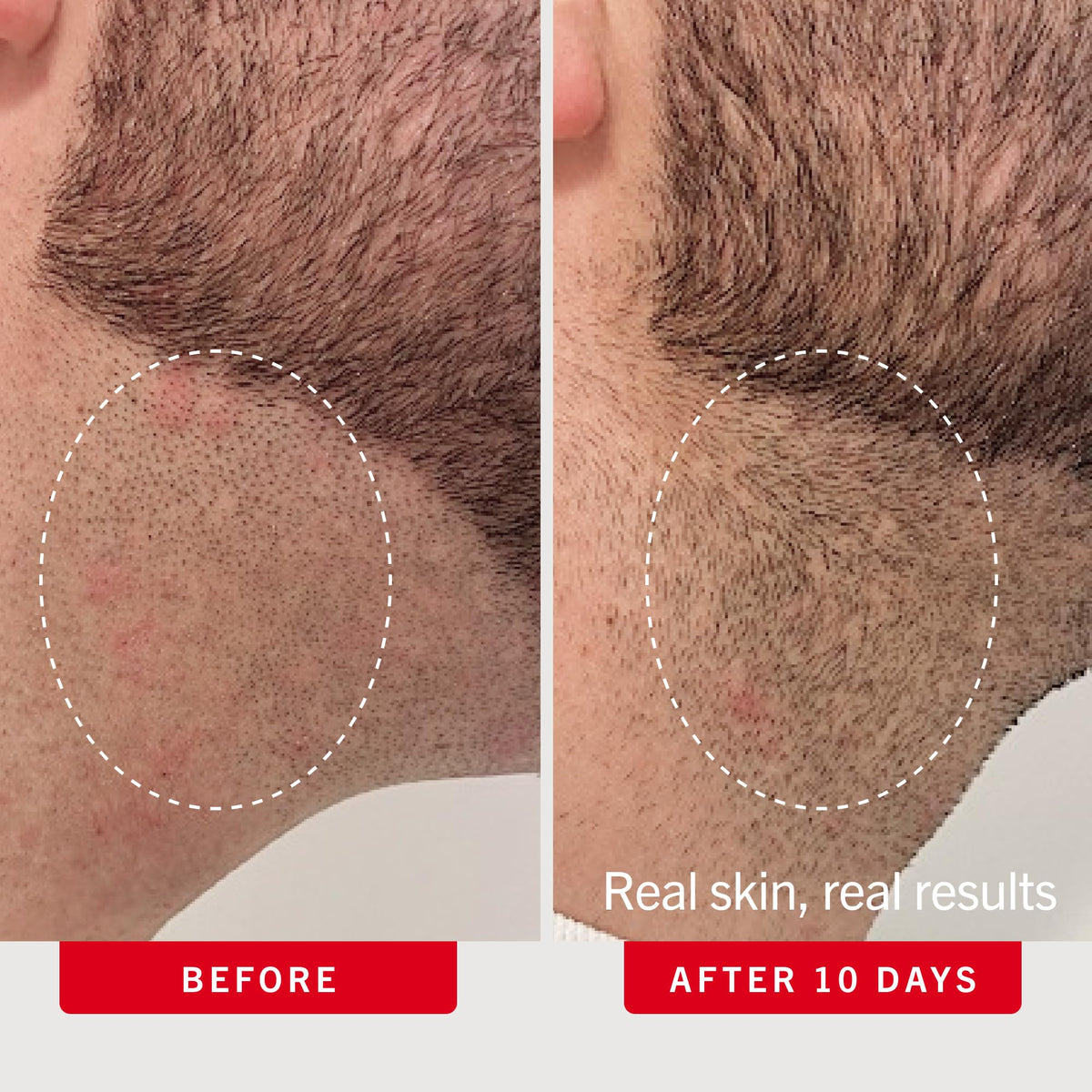 First Aid Beauty Ingrown Hair Pads open packaging showing pads