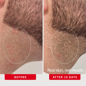 First Aid Beauty Ingrown Hair Pads open packaging showing pads