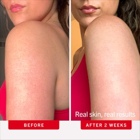 First Aid Beauty KP Bump Eraser Scrub 10% AHA ingredients