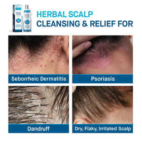 Front view of Roycederm Scalp Cream tube